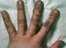 HUMAN PAPILLOMA VIRUS - HAND