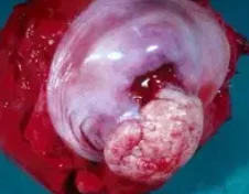HUMAN PAPILLOMA VIRUS - CERVIX