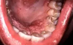 HUMAN PAPILLOMA VIRUS - ORAL