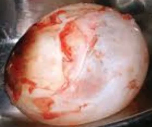 LUNG HYDATID CYST