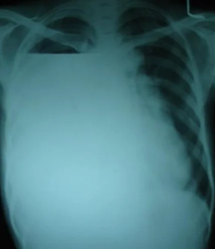 INTRAPLEURAL RUPTURE OF HYDATID CYST