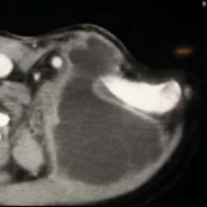 HYDATID CYST - SUPRACLAVICULAR 