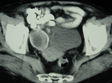 HYDATID CYST - OVARY