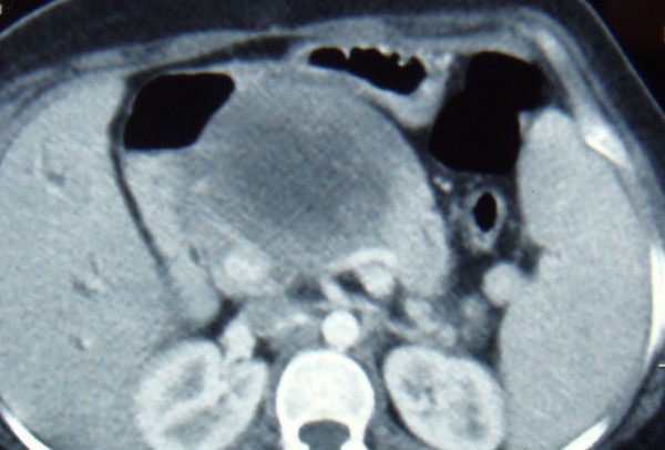 HYDATID CYST - PANCREAS