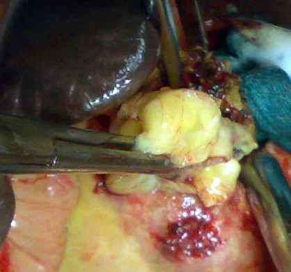 HYDATID CYST - PANCREAS 