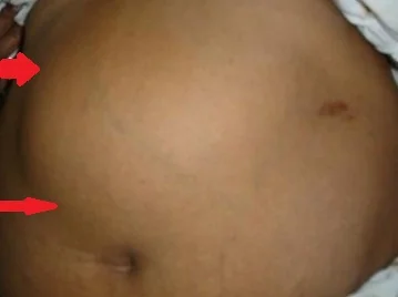 HYDATID CYST