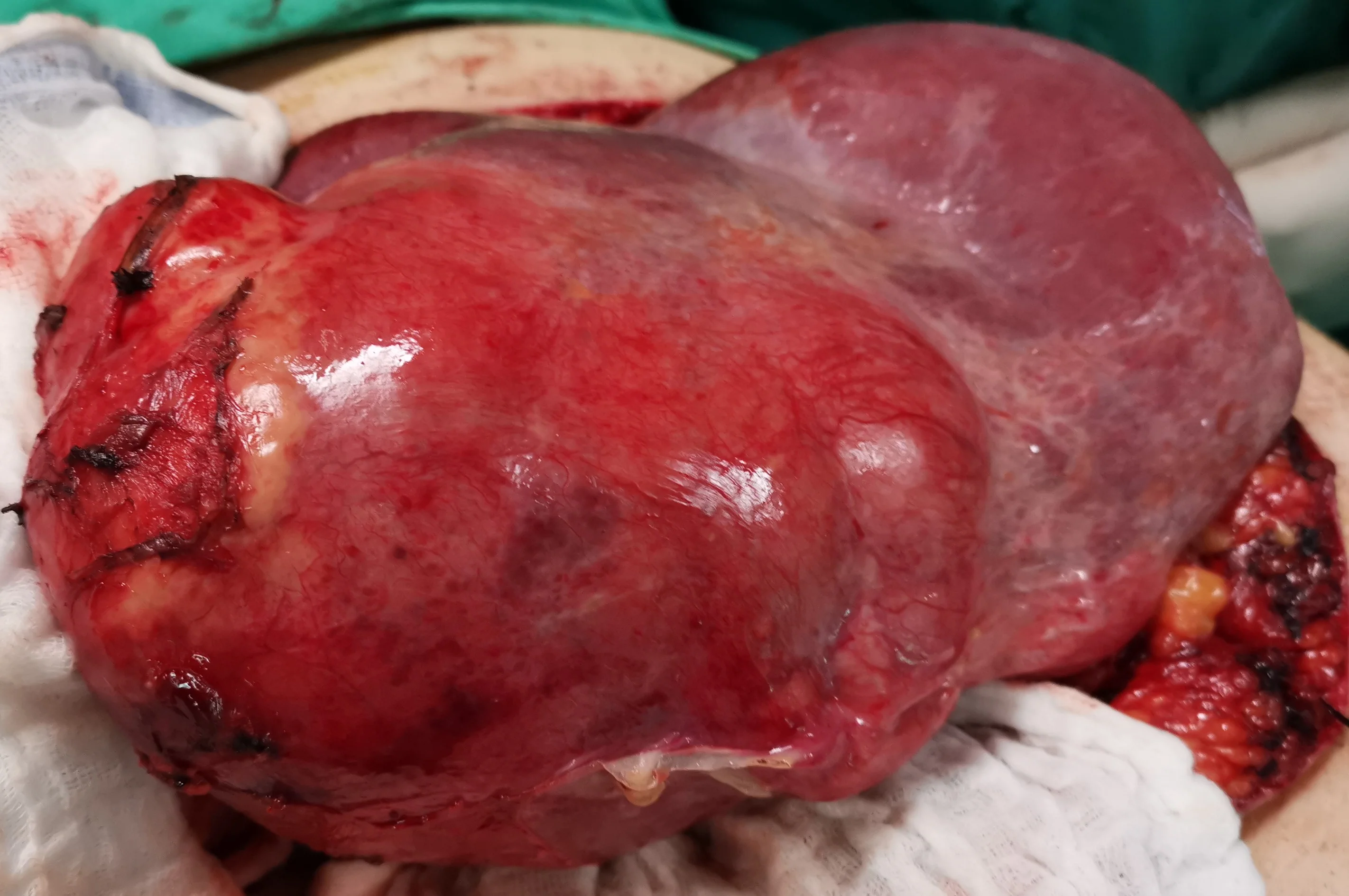 HYDATID CYST