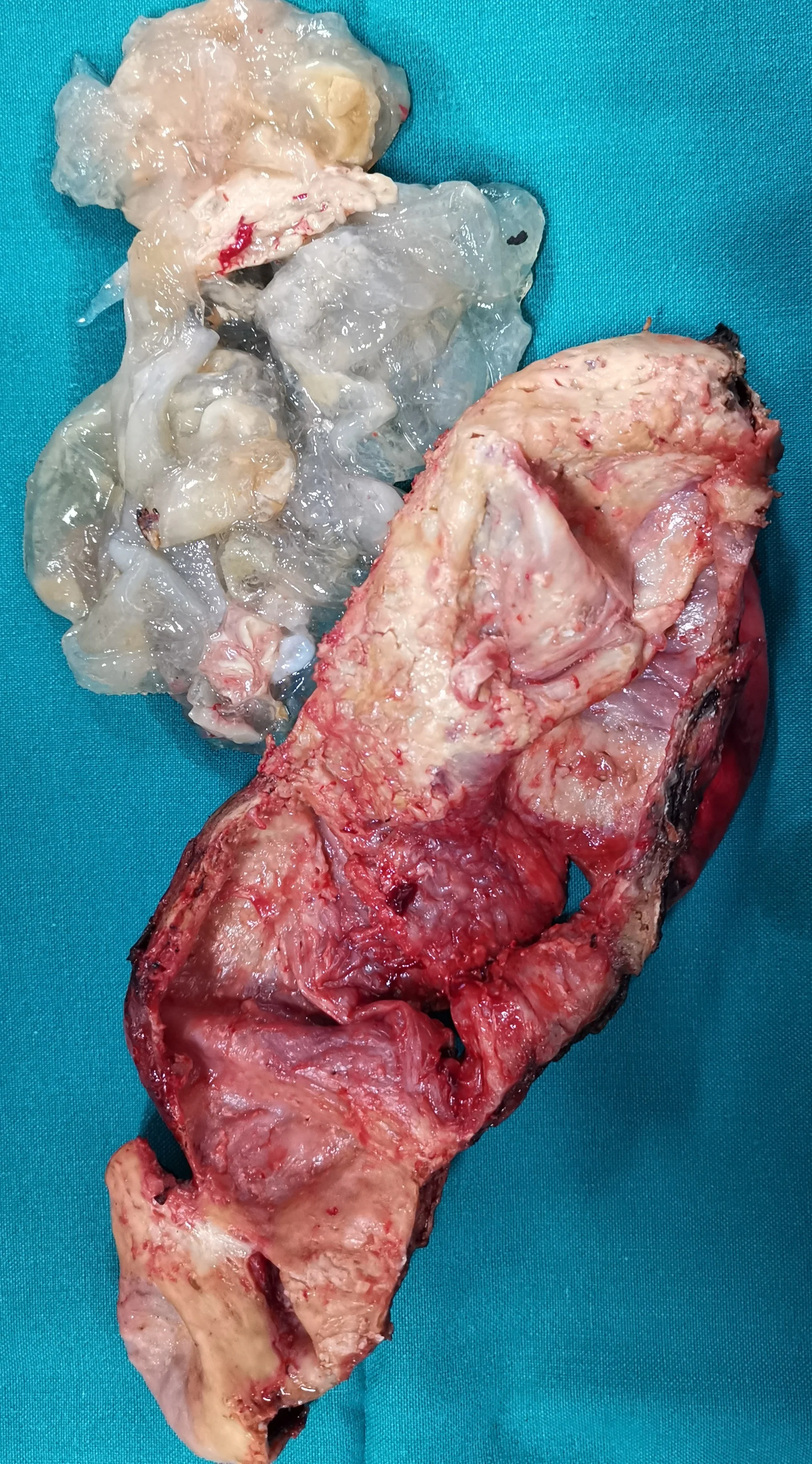 HYDATID CYST