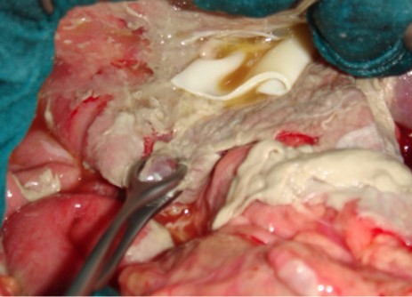 INTRAPERITONEAL RUPTURE HYDATID CYST