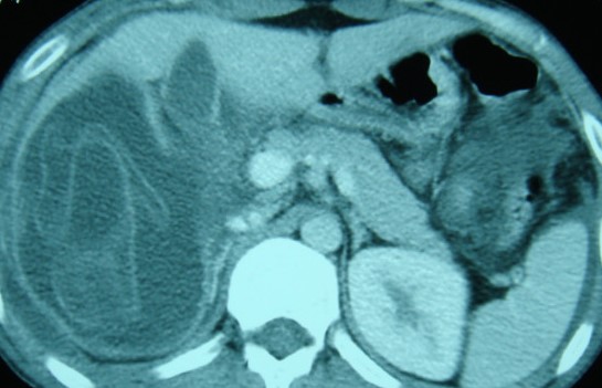 INTRAPERITONEAL RUPTURE HYDATID CYST 