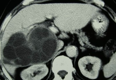 LIVER HYDATID CYST 