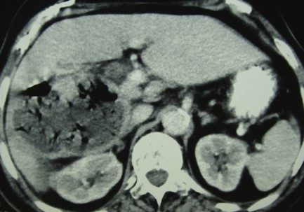 LIVER HYDATID CYST