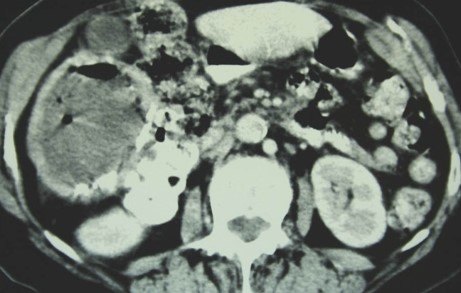 LIVER HYDATID CYST