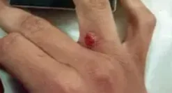 MILKER'S NODULE