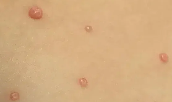 MOLLUSCUM CONTAGIOSUM