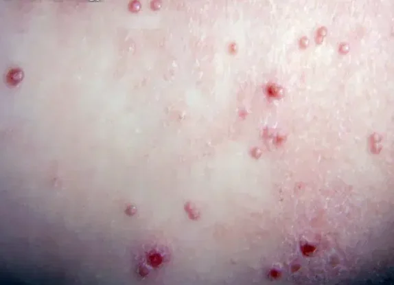 MOLLUSCUM CONTAGIOSUM 