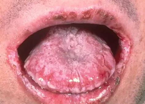 ORAL CANDIDIASIS