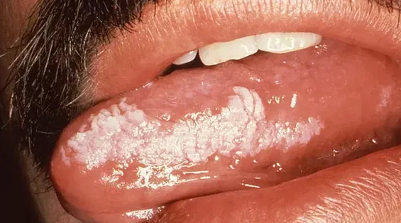 ORAL HAIRY LEUKOPLAKIA