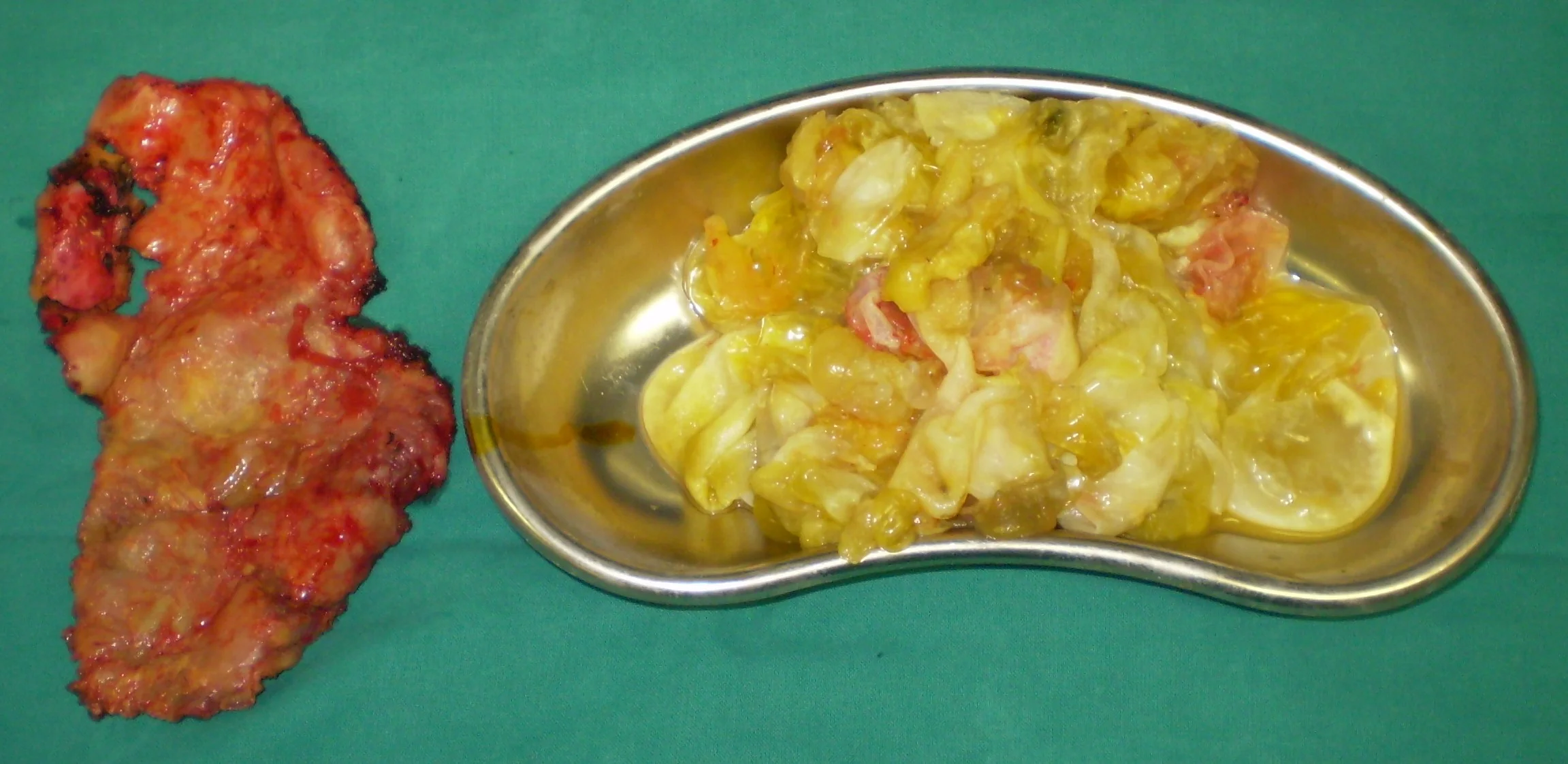 DAUGHTER HYDATID CYSTS