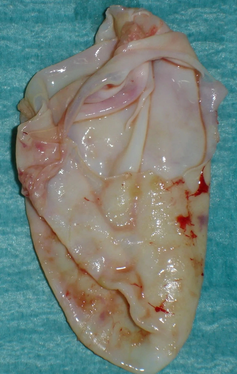 HYDATID CYST 