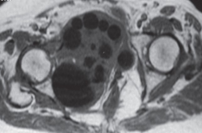 PELVIC HYDATID CYST 