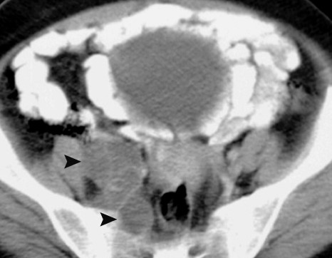 PELVIC HYDATID CYST