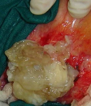 PERITONEAL HYDATIDOSIS