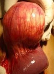 PERITONEAL HYDATIDOSIS