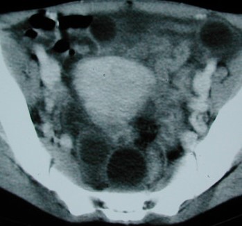 PERITONEAL HYDATIDOSIS 