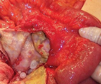 PERITONEAL HYDATIDOSIS