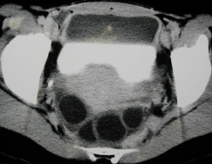 PERITONEAL HYDATIDOSIS