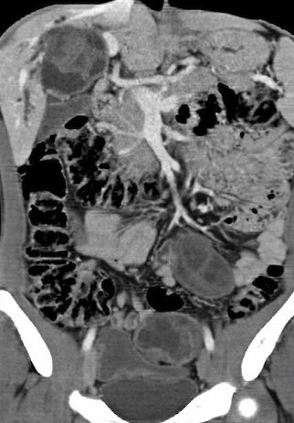 PERITONEAL HYDATIDOSIS