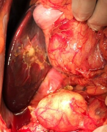 PERITONEAL HYDATIDOSIS
