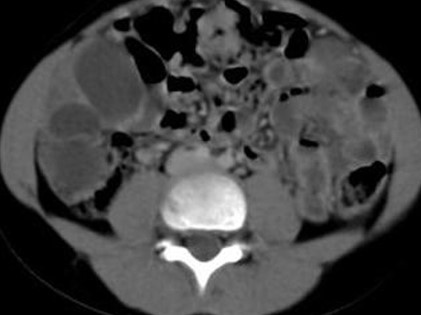 PERITONEAL HYDATIDOSIS