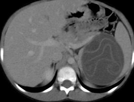 PERITONEAL HYDATIDOSIS