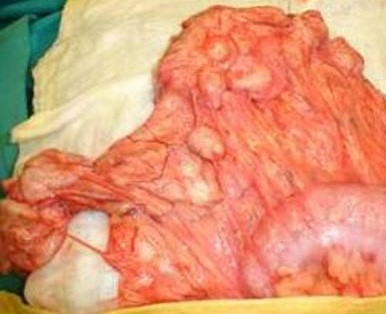 PERITONEAL HYDATIDOSIS