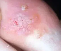 PLANTAR WARTS
