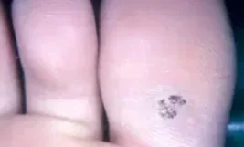 PLANTAR WARTS