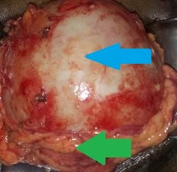 PRIMARY OMENTAL HYDATID CYST