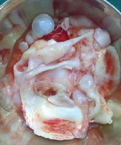 PELVIC HYDATID CYST 