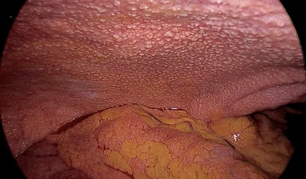 TUBERCULOUS PERITONITIS