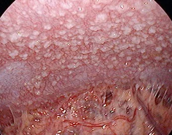 TUBERCULOUS PERITONITIS