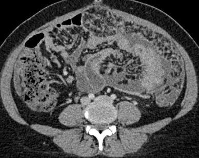 TUBERCULOUS PERITONITIS
