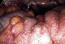 TUBERCULOUS PERITONITIS