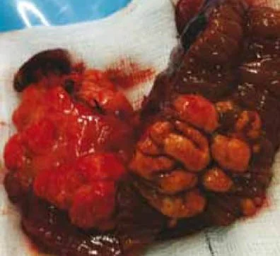 INFECTED MESENTERIC CYST