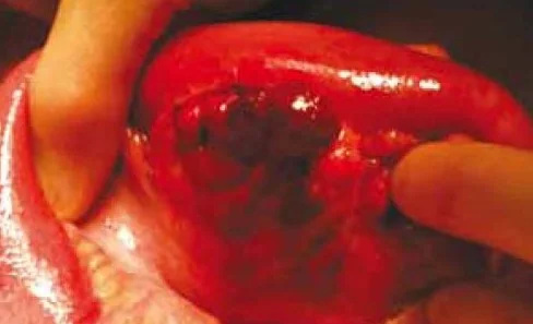 MESENTERIC CYST