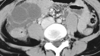 INFECTED MESENTERIC CYST 