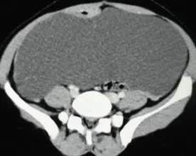 LARGE MESENTERIC CYST