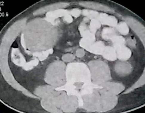 MESENTERIC DESMOID TUMOR