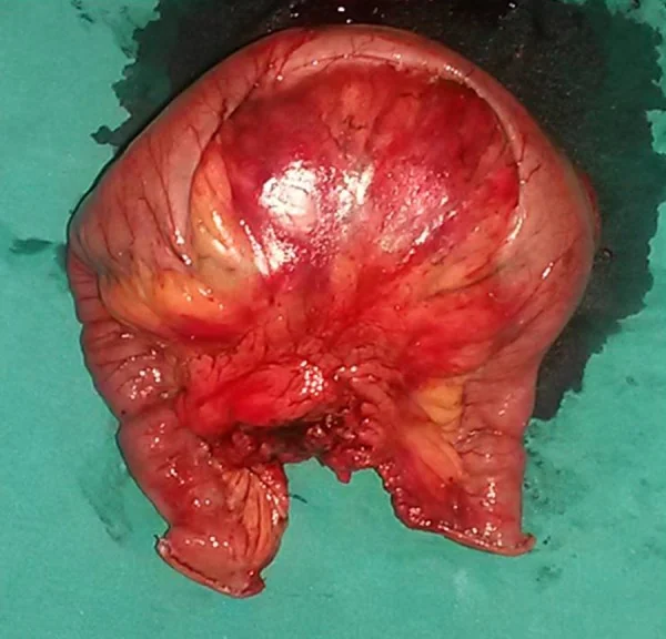 MESENTERIC DESMOID TUMOR